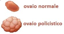aborto da ovaio policistico