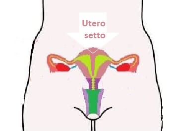 Aborto da utero setto